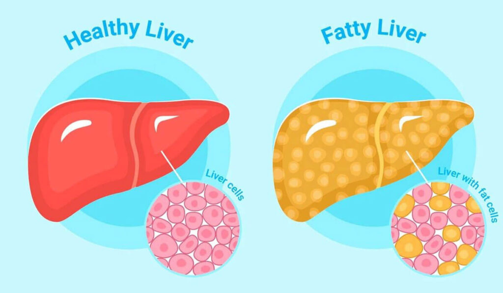 fatty-liver-disease-sounds-scary-but-it-s-possible-to-reverse-it-storymd