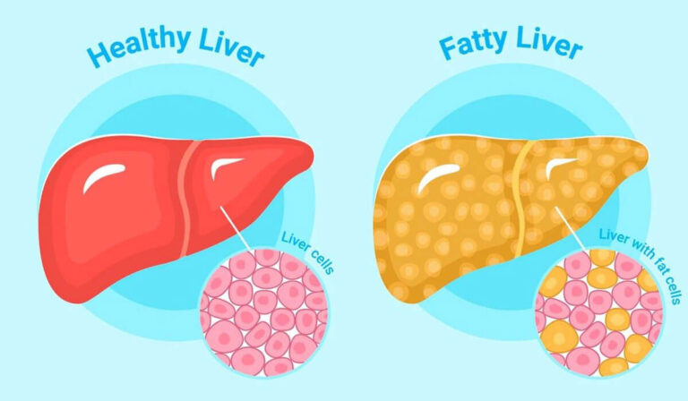 What Vitamin Helps with a Fatty Liver